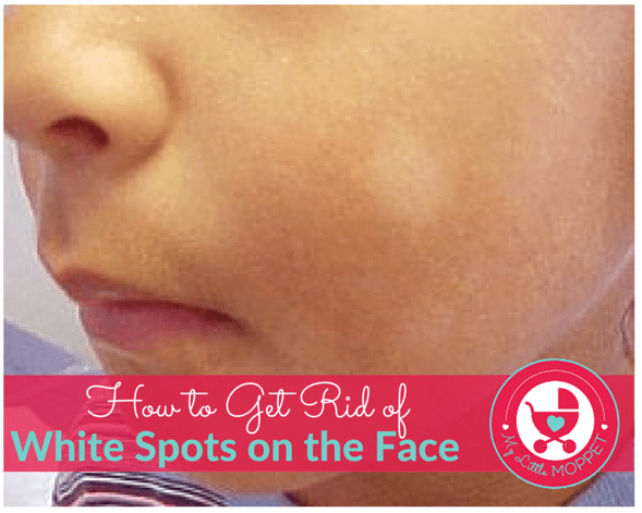 Dry skin above lip how to get rid of it